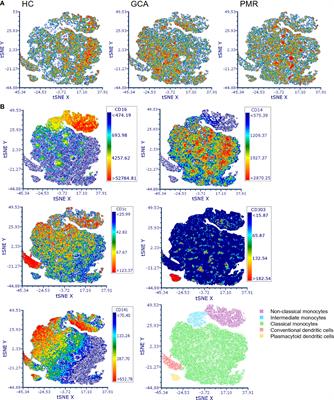 Aberrant phenotype of circulating antigen presenting cells in giant cell arteritis and polymyalgia rheumatica